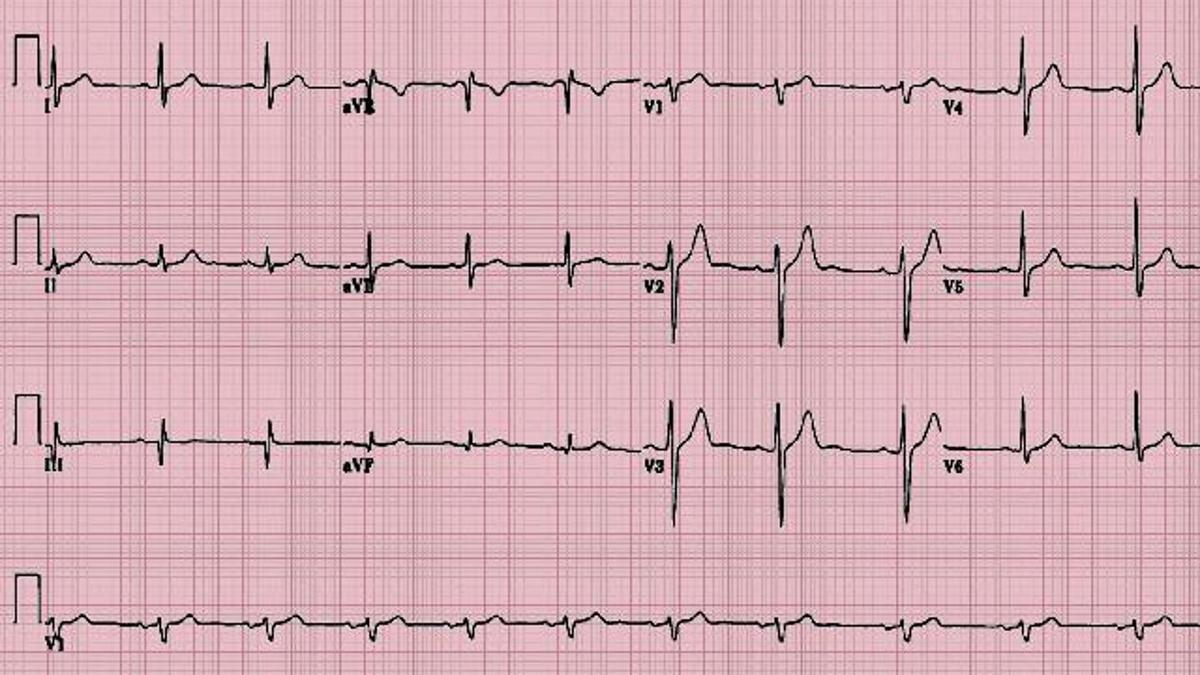 Ekg Nedir, Neden Çekilir? Elektrokardiyografi Nasıl Yapılır?