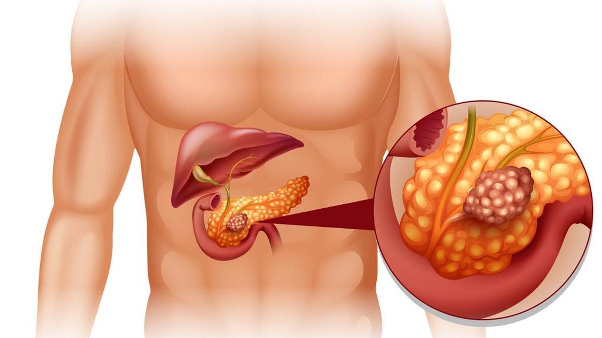 Pankreas Ağrısı Nasıl Olur? Pankreas Ağrısı Hangi Hastalıkların Belirtisi Olabilir?