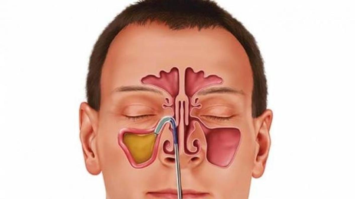 Sinüzit İçin Doğal Tedavi Yöntemleri Nelerdir? Sinüzit Doğal Yollarla Nasıl Geçer?