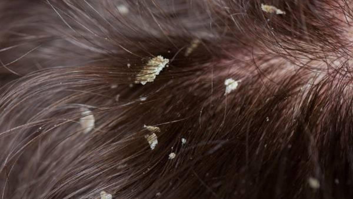 Seboreik Dermatit Nedir, Belirtileri Nelerdir? Seboreik Dermatit Tedavisi Nasıl Yapılır?