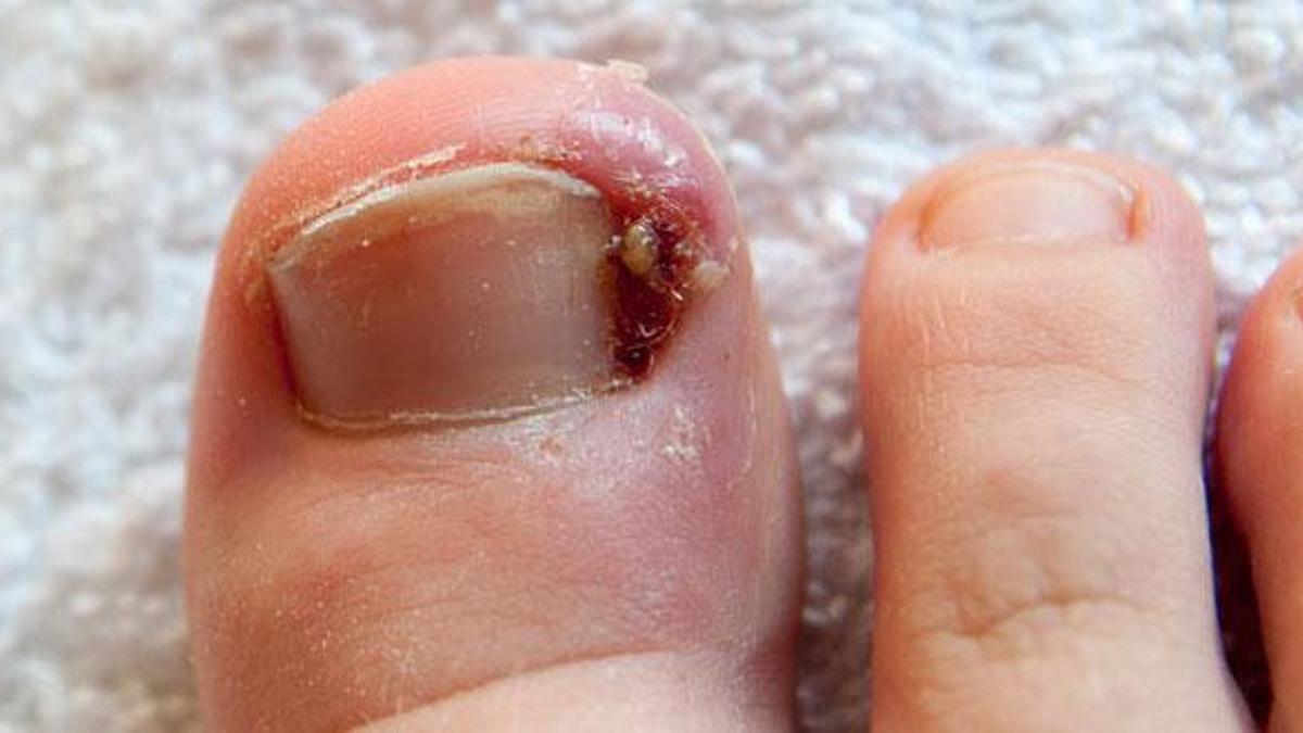 Tırnak Batması İçin Hangi Doktora Gidilir? Tırnak Batmasına Hangi Bölüm Bakar?