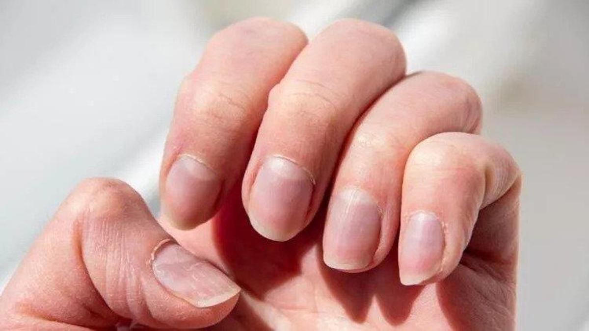 Tırnak sağlığını ihmal etmeyin! Tırnak İçin Hangi Doktora Gidilir? Tırnak Hastalıklarına Hangi Bölüm Bakar?