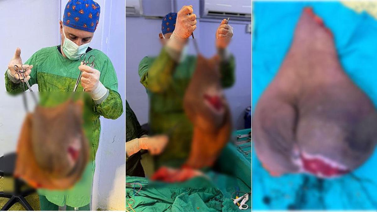 Hastanın karnından çıkarıldı: Tam 40 kilogram
