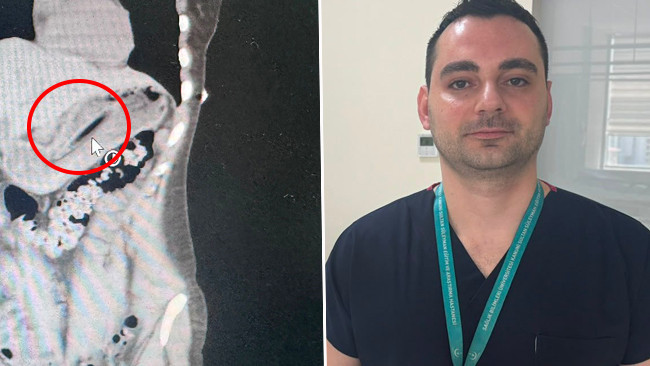 Kilo vermek için yaptı, ameliyata alındı! Doktorlar hayrete düştü: '13 santimetrelik cisim nasıl yutulur?'