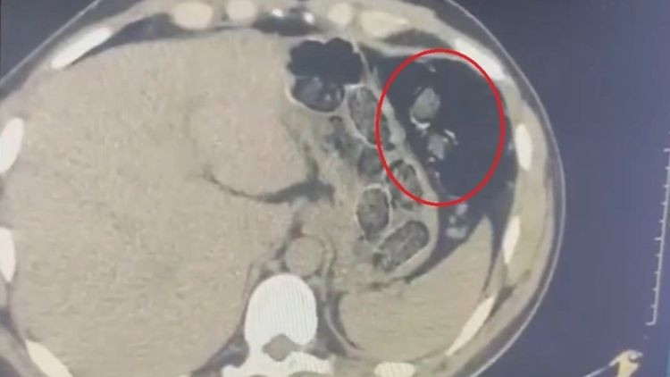 Midelerinden uyuşturucuyla yakalanan 2 şüpheli tutuklandı